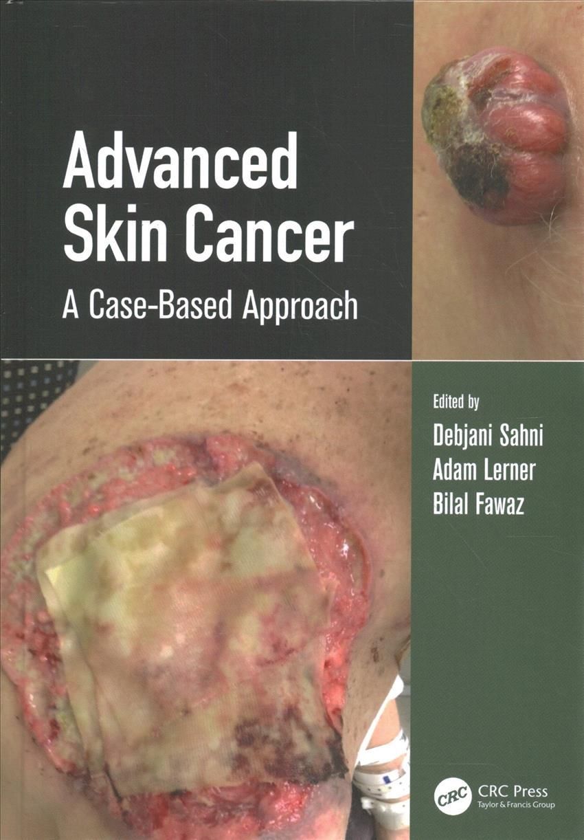 Advanced Skin Cancer 9780367134716 (Hardback)