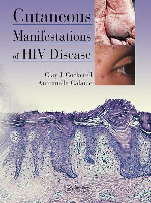 Cutaneous Manifestations of HIV Disease By Clay Cockerell (Paperback)