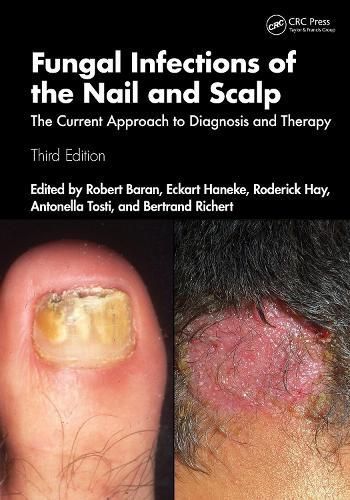 Fungal Infections of the Nail and Scalp 9781032464305 (Paperback)