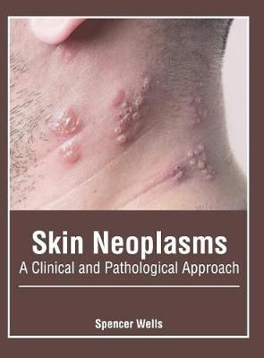 Skin Neoplasms: A Clinical and Pathological Approach By Spencer Wells