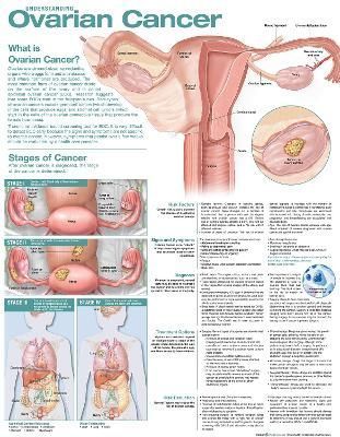 Understanding Ovarian Cancer Anatomical Chart 9781975192327