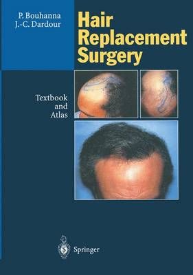 Hair Replacement Surgery 9783642796142 (Paperback)