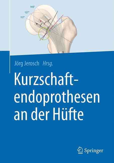 Kurzschaftendoprothesen an Der Hüfte By Jörg Jerosch (editor)