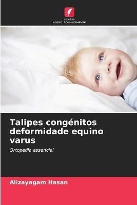 Talipes congénitos deformidade equino varus By Hasan 9786205606681