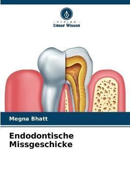 Endodontische Missgeschicke By Bhatt 9786205612972 (Paperback)