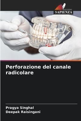 Perforazione del canale radicolare By Singhal 9786205688700