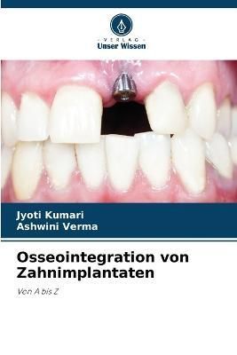 Osseointegration von Zahnimplantaten By Kumari 9786205712474