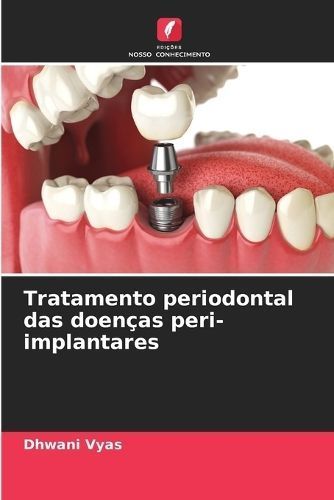 Tratamento Periodontal Das Doenças Peri-Implantares By Dhwani Vyas