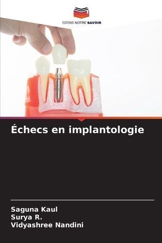 Échecs en implantologie By Kaul 9786206307099 (Paperback)