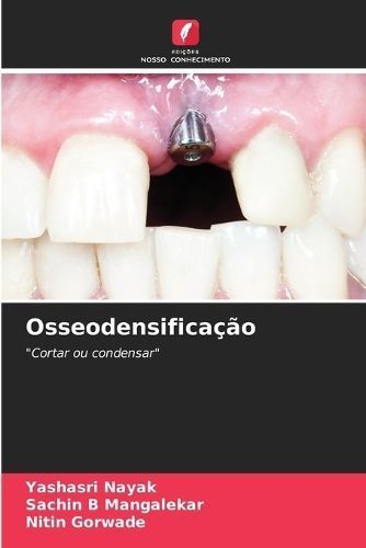 Osseodensificação 9786206892953 (Paperback)