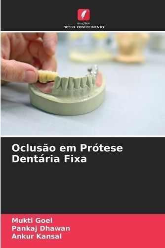 Oclus?o em Pr?tese Dent?ria Fixa By Goel 9786207229673 (Paperback)