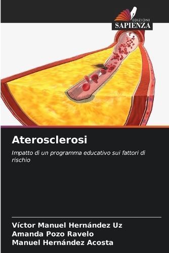 Aterosclerosi 9786207302567 (Paperback)