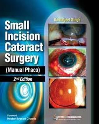 Small Incision Cataract Surgery (Manual Phaco) By Kamaljeet Singh