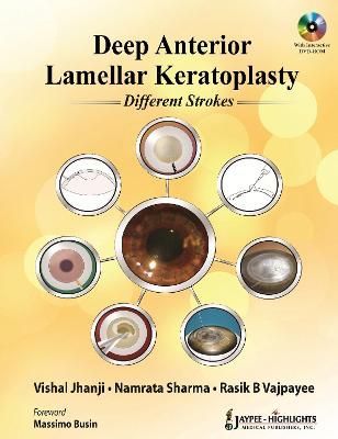Deep Anterior Lamellar Keratoplasty 9789350256329 (Paperback)