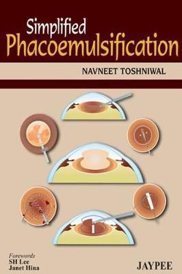 Simplified Phacoemulsification By Navneet Toshniwal 9789350904428